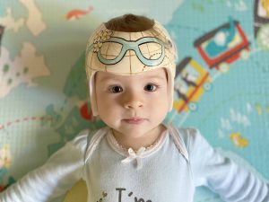 helmet therapy for baby head shape