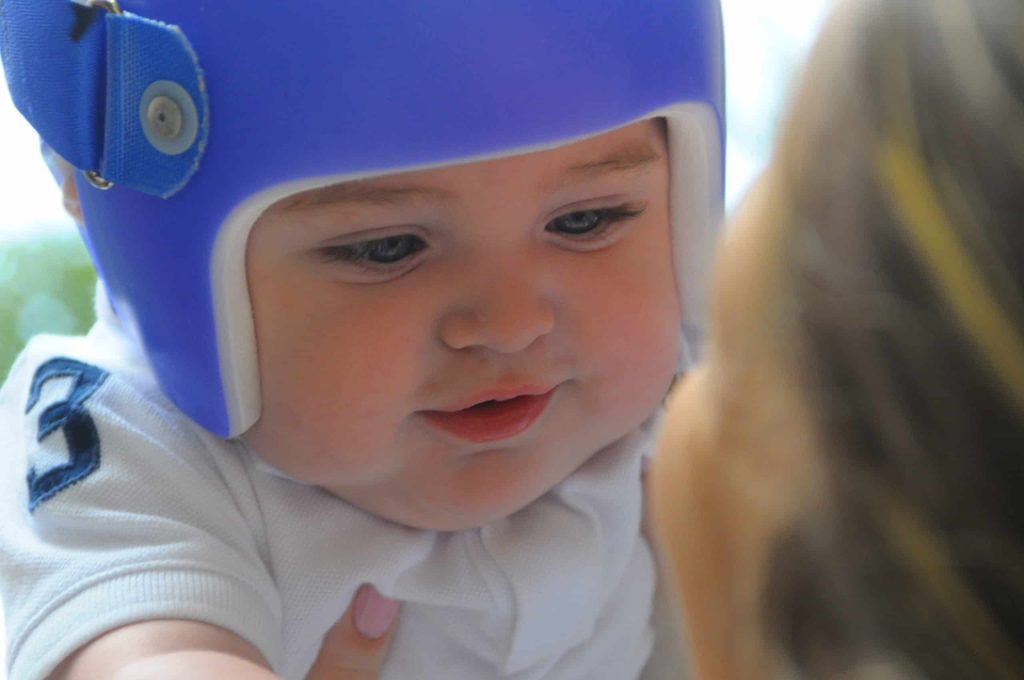 baby head shape helmet therapy 