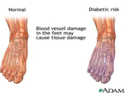 foot care for diabetic